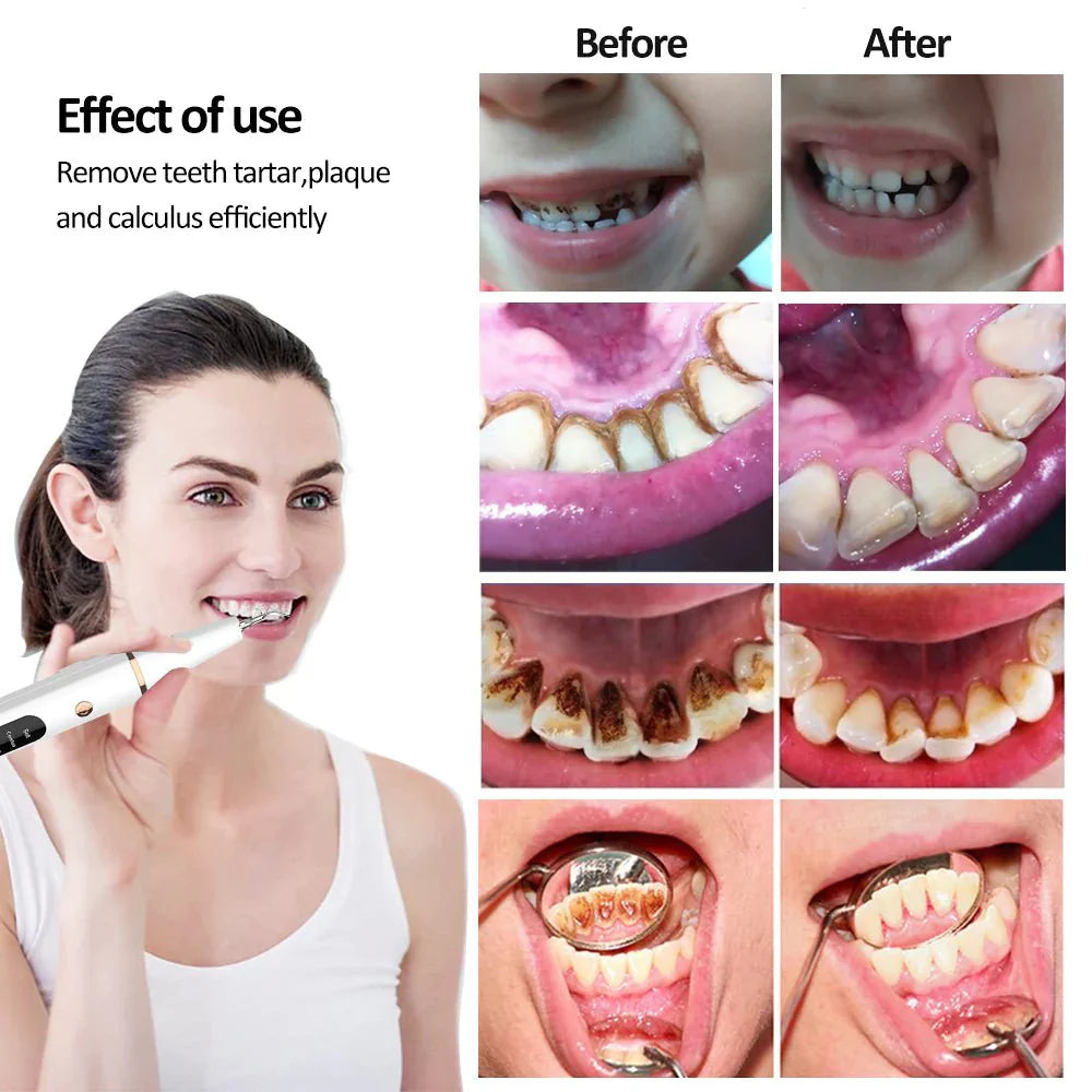 SmilePro2™ جهاز تقشير تكلس وتبيض الأسنان بالموجات فوق الصوتية - Makfool